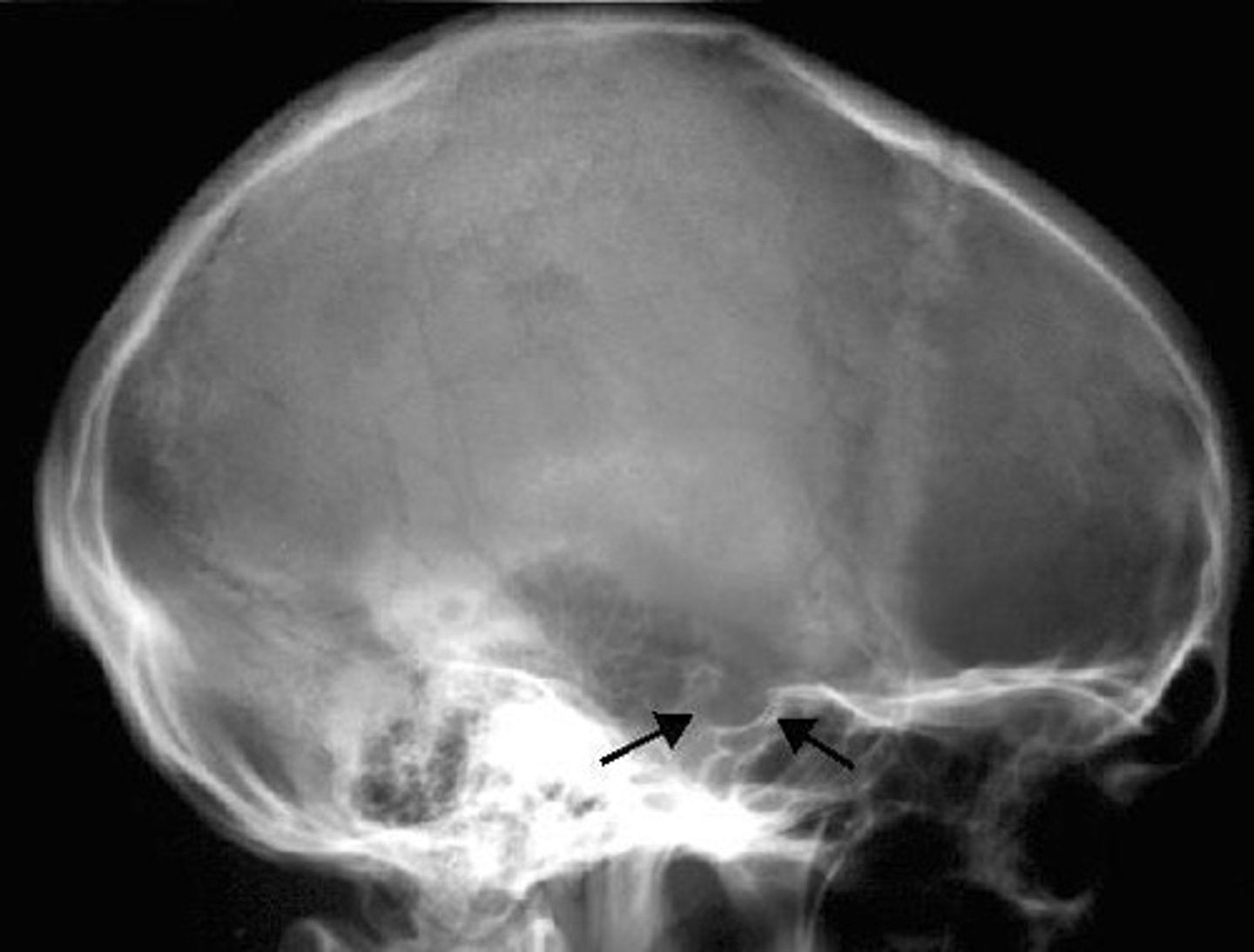 <p>An extension of the temporal bone at the level of the ear lobe.</p>
