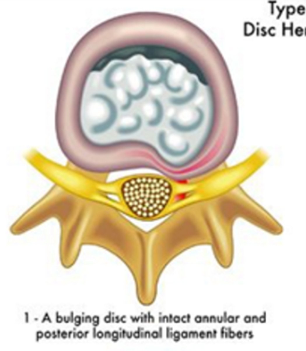 <p>disc bulge, but NO rupture of annulus fibrosis</p>