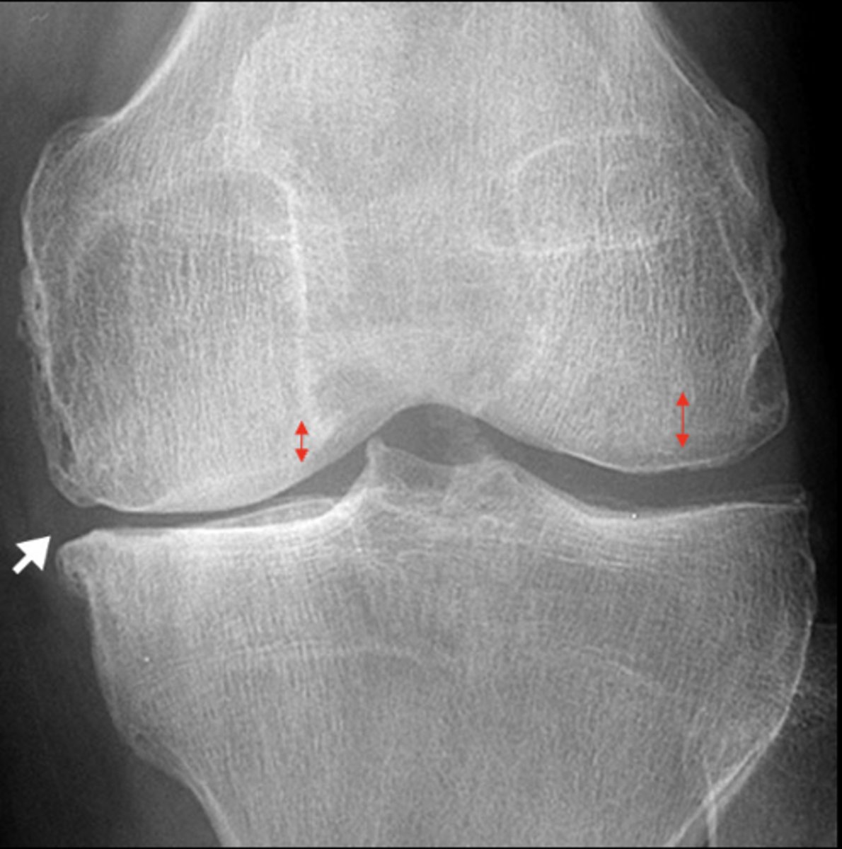 <p>Degenerative _____ loss of joint space</p>
