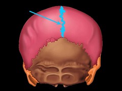 <p>separates the left and right parietal bone</p>