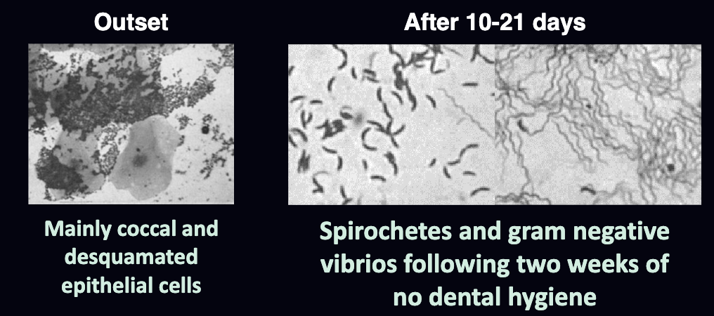 <p><span>Removal of plaque leads to resolution of gingival inflammation.  </span></p>