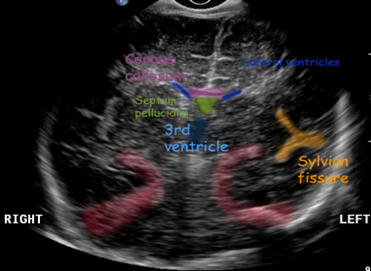 <p>frontal horns of lateral ventricle *always in image*</p><p>sylvian fissure (bright spot)</p><p>cavum septum pellucidum </p>