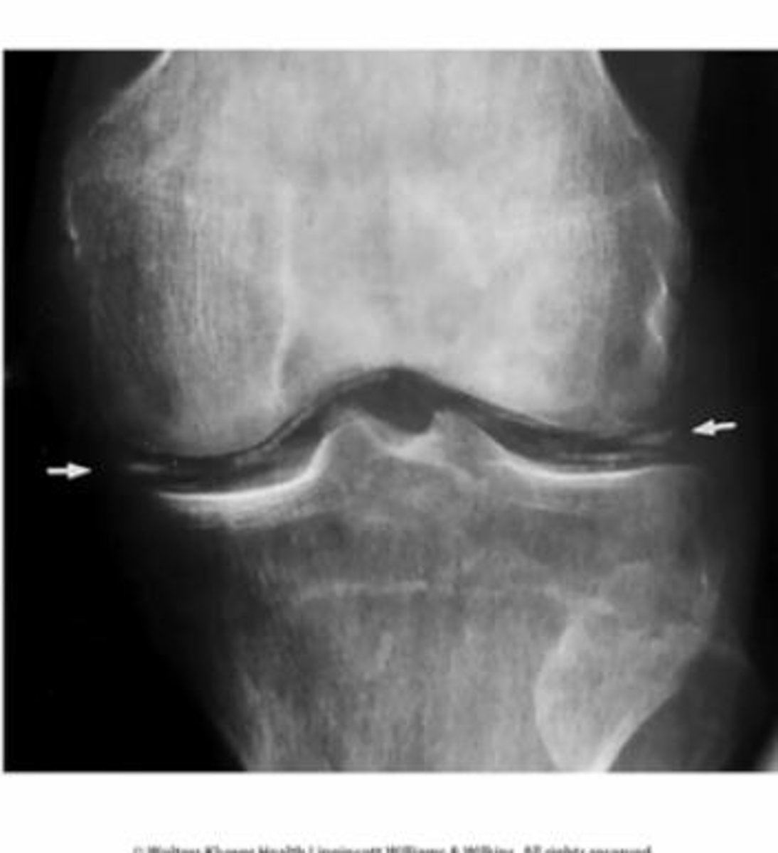 <p>Radiographic finding of fine, linear calcifications in cartilage diagnostic of pseudogout</p><p>- most commonly due to CPPD in the joints</p>