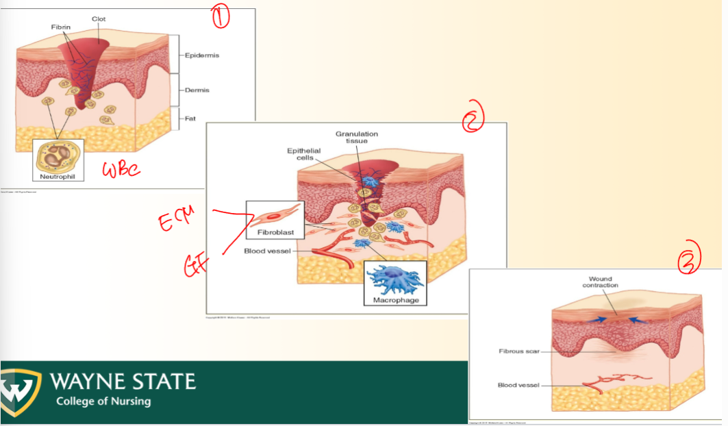 <ol><li><p>Inflammation</p><ol><li><p>Vascular phase: vasodilate + permeability</p></li><li><p>Cellular phase: macrophages, phagocytes, etc.</p></li><li><p>WBCs: NBELm/m</p></li></ol></li><li><p>Proliferation, Granulation tissue formation, Epithelization</p><ol><li><p>Fibroblasts = extracellular matrix or growth factors</p></li><li><p>Proliferation = phase following initial inflammation where new tissue is formed</p></li><li><p>Granualtion tissue: highly vascularized, new CT, fibroblasts, and and extra cellular matrix (INTIAL PHASE where CT and BLOOD VESSELS froma round wound)</p></li><li><p>Epithelization = Growth of EPITHELIAL CELLS  over a wound </p><ol><li><p>Granulation b4 epithelization</p></li></ol></li></ol></li><li><p>Wound contraction + remodeling</p></li></ol><p>KNOW DIAGRAM PLS</p>