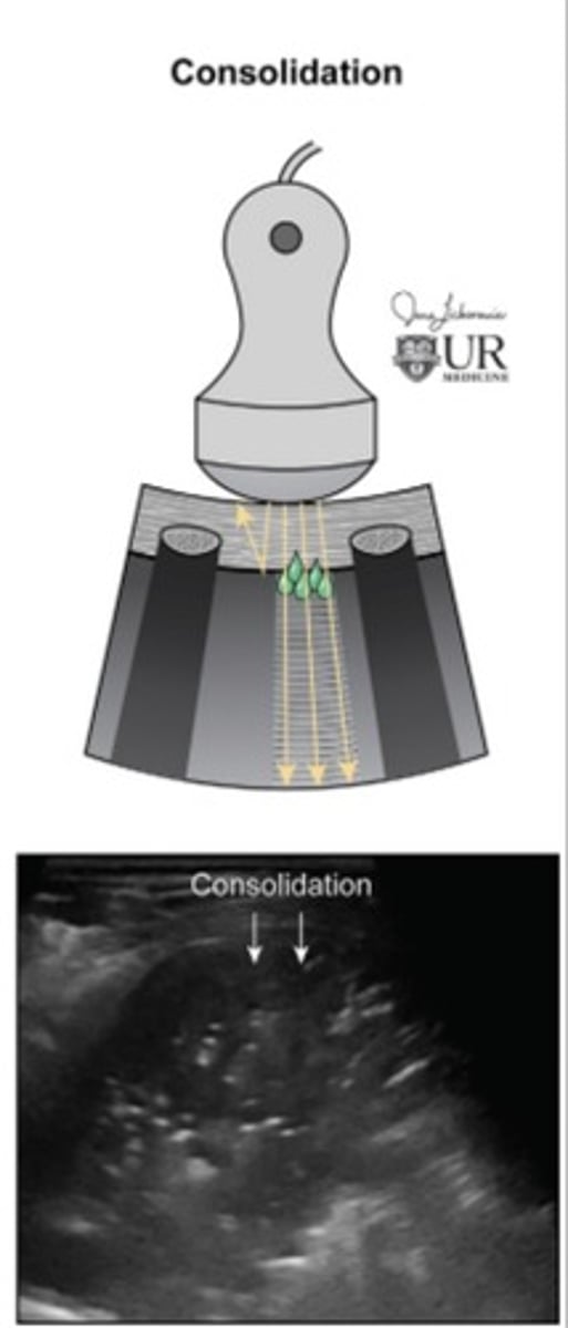<p>Fluid fills alveoli</p><p>Normal A-Lines and air in lungs are lost</p><p>Lung looks like liver tissue</p>