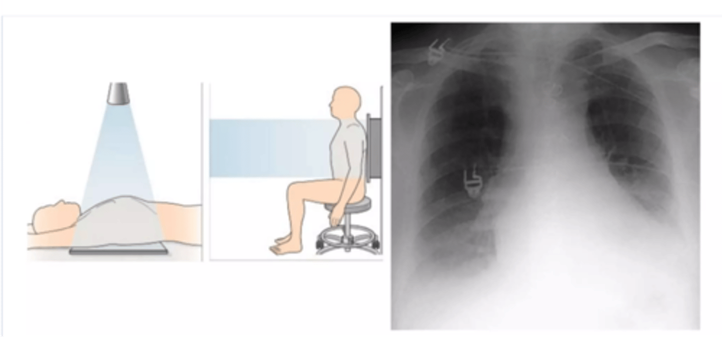 <p>-anteroposterior view</p><p>-beam travels front to back</p><p>-heart appears large</p>