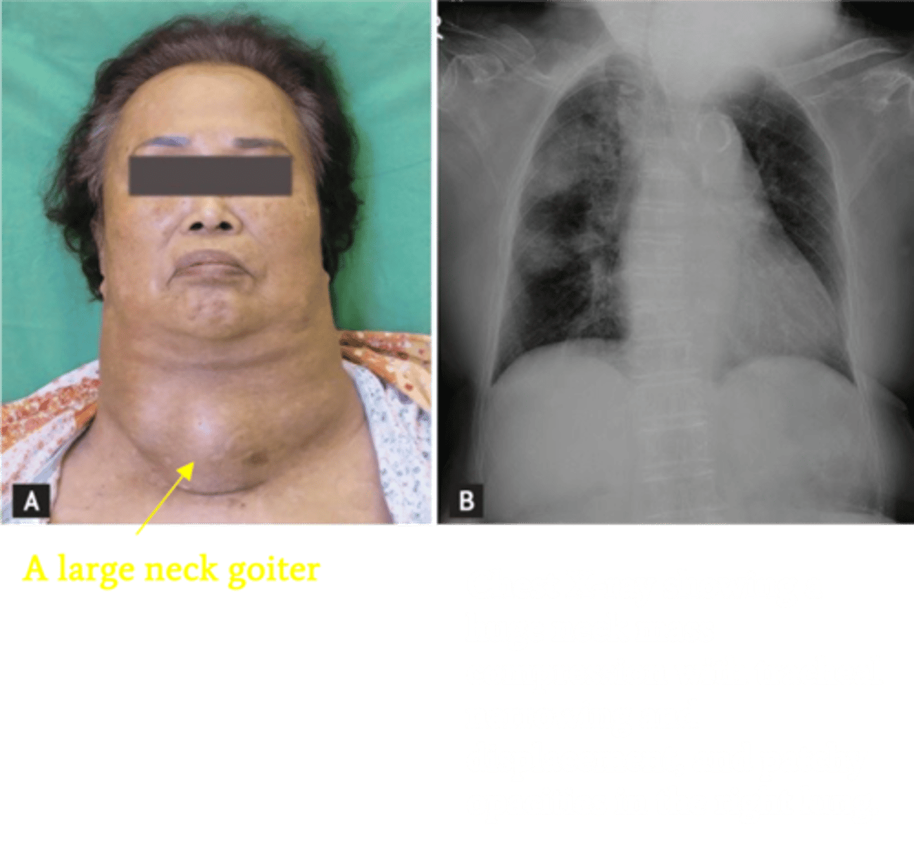<p>Define Condition:</p><p>Mechanical external compression by a benign or malignant mass</p><p>-Sx:</p><p>&gt; Dysphagia</p><p>&gt; Choking on food</p><p>&gt; Progressive DOE</p>