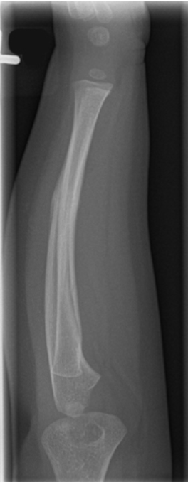 <p>what fracture type is this </p>