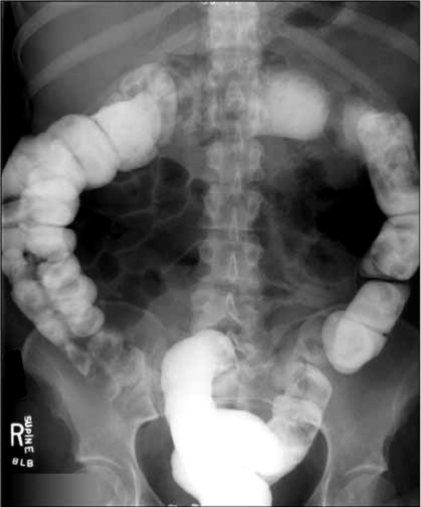 <p>large bowel</p>