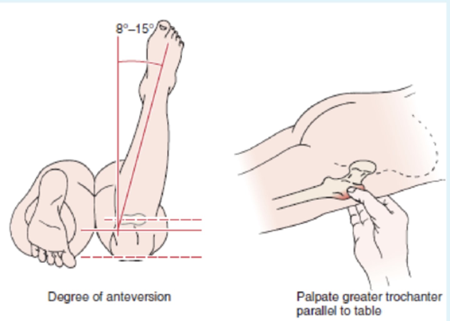 <p>- identify abnormal femoral anteversion</p><p>Procedure:</p><p>- The patient lies prone with the knee flexed to 90°. The examiner palpates the posterior aspect of the greater trochanter of the femur. The hip is then passively rotated medially and laterally until the greater trochanter is parallel with the examining table or reaches its most lateral position.</p><p>(+): degree of anteversion can be estimated based on the angle of lower leg with the vertical</p><p>Normal: 8-15 degrees of IR</p><p>Anteversion: angle > 15 degrees; pigeon toed or in-toeing & increase IR</p><p>Retroversion: angle < 8 degrees; out-toeing & increased ER</p>