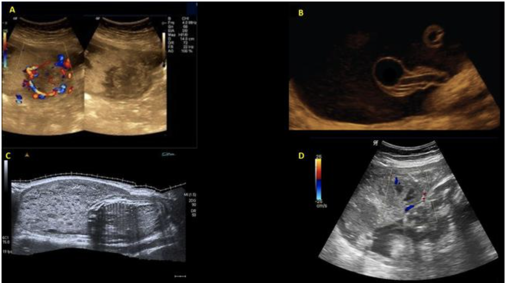 <p>chorioangioma is supected. which image shows it </p><p>a) A</p><p>b) B</p><p>c) C</p><p>d) D</p>