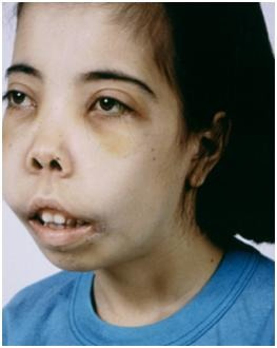 <p>characteristic of beta thalassemia characterized by wide spaced eyes, prominent forehead, overgrowth of maxillae</p>