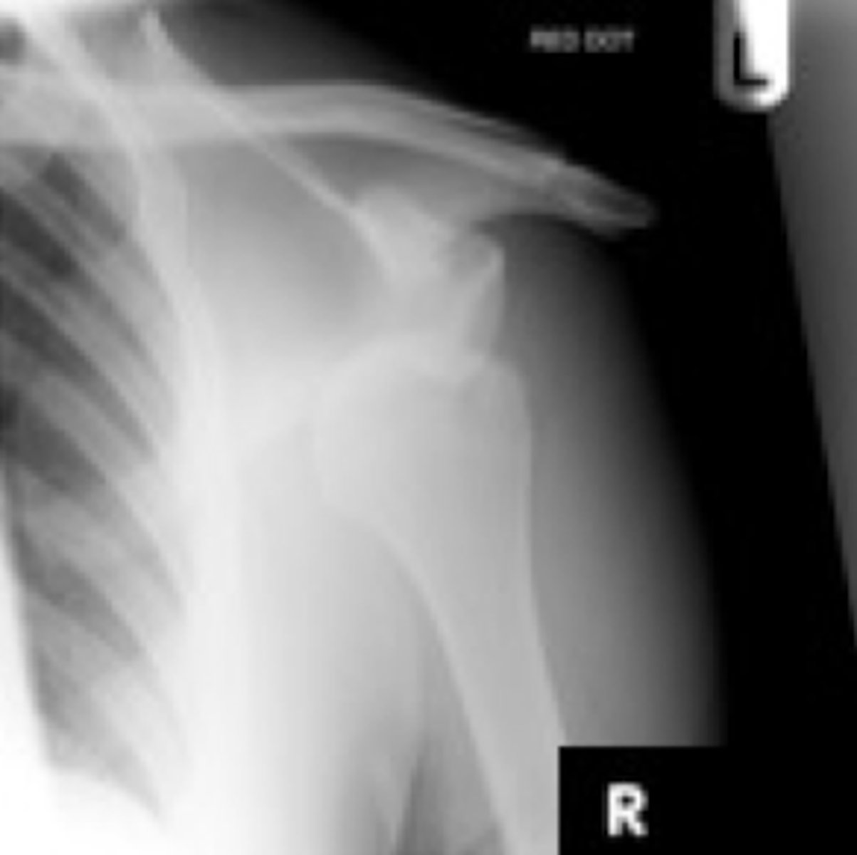 <p>compression fracture of posterior humeral head due to ANTERIOR dislocation</p>