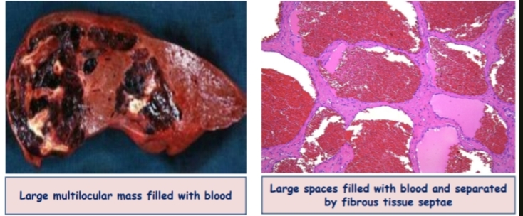 <p><strong>Hamartoma</strong> (cavernous hemangioma)</p><p>1-Large multilocular mass filled with blood</p><p>2-Large spaces filled with blood and separated by fibrous tissue septae</p><p>Most common organ is liver</p>