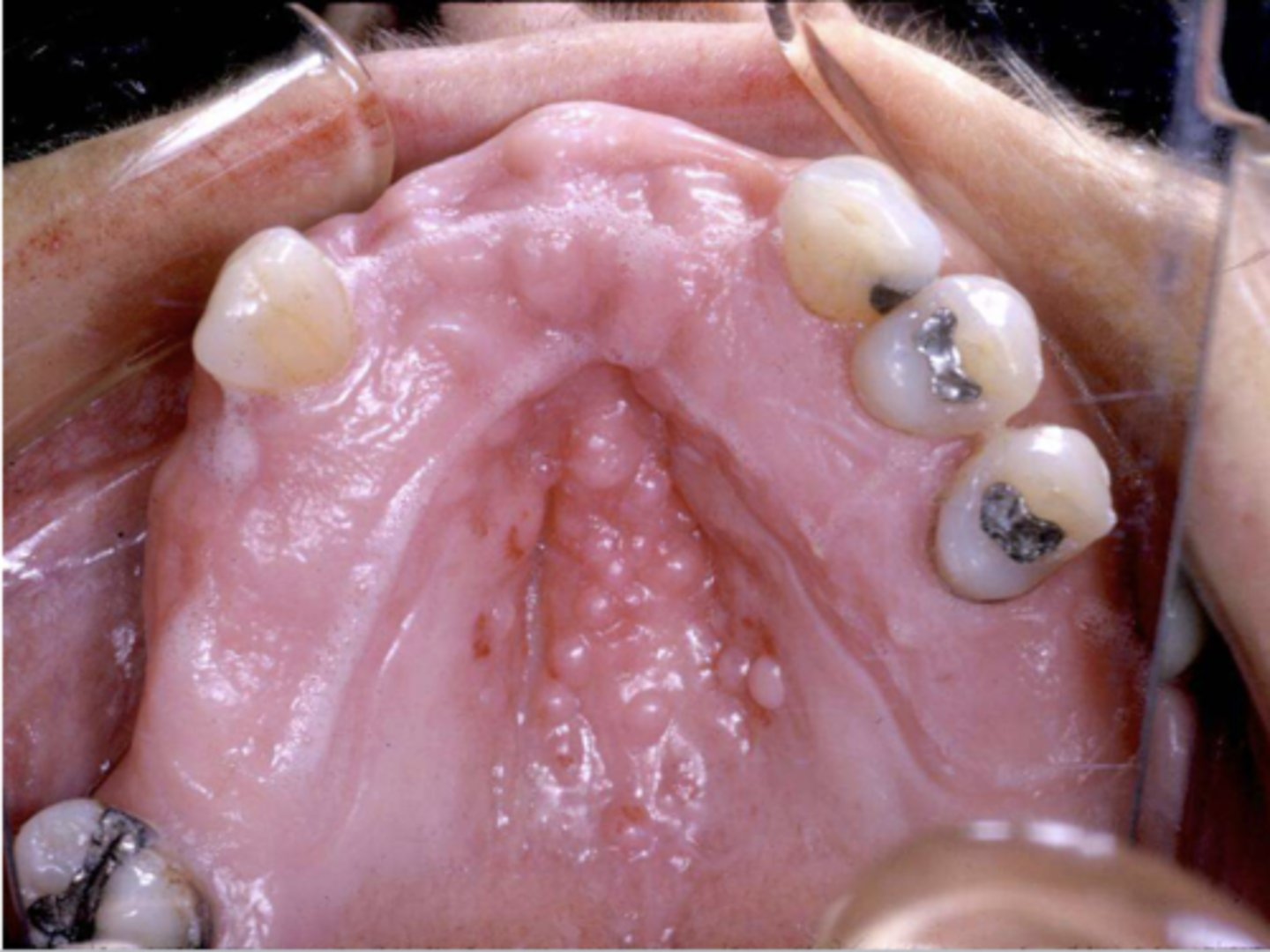 <p>what are these clinical features of?</p><p>-hard palate beneath denture base</p><p>-pink or pebbly mucosa</p><p>-erythema --> suggests secondary candidal infection</p>