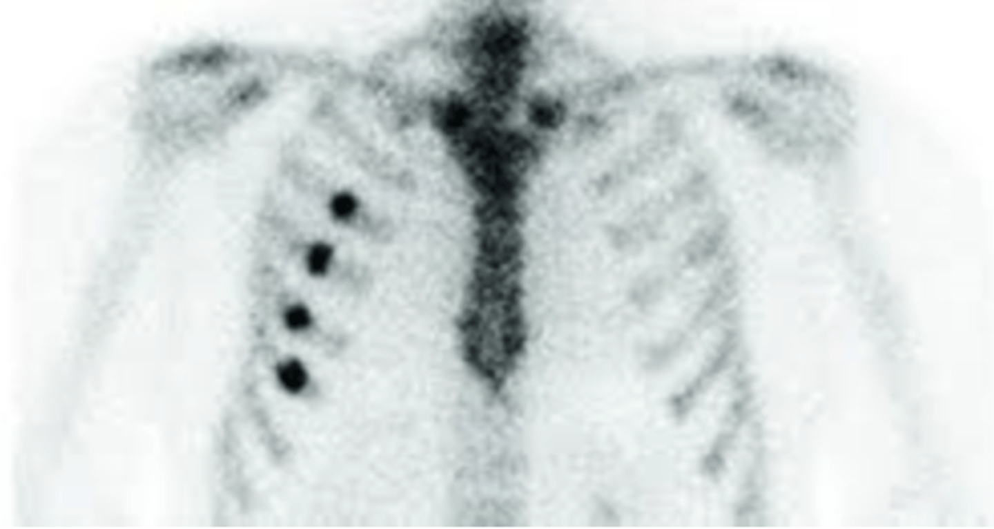 <p>rib fractures after a trauma</p>