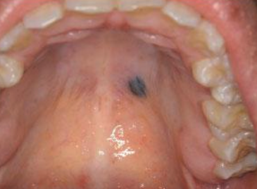 <p>What is the treatment for acquired melanocytic nevus?</p>