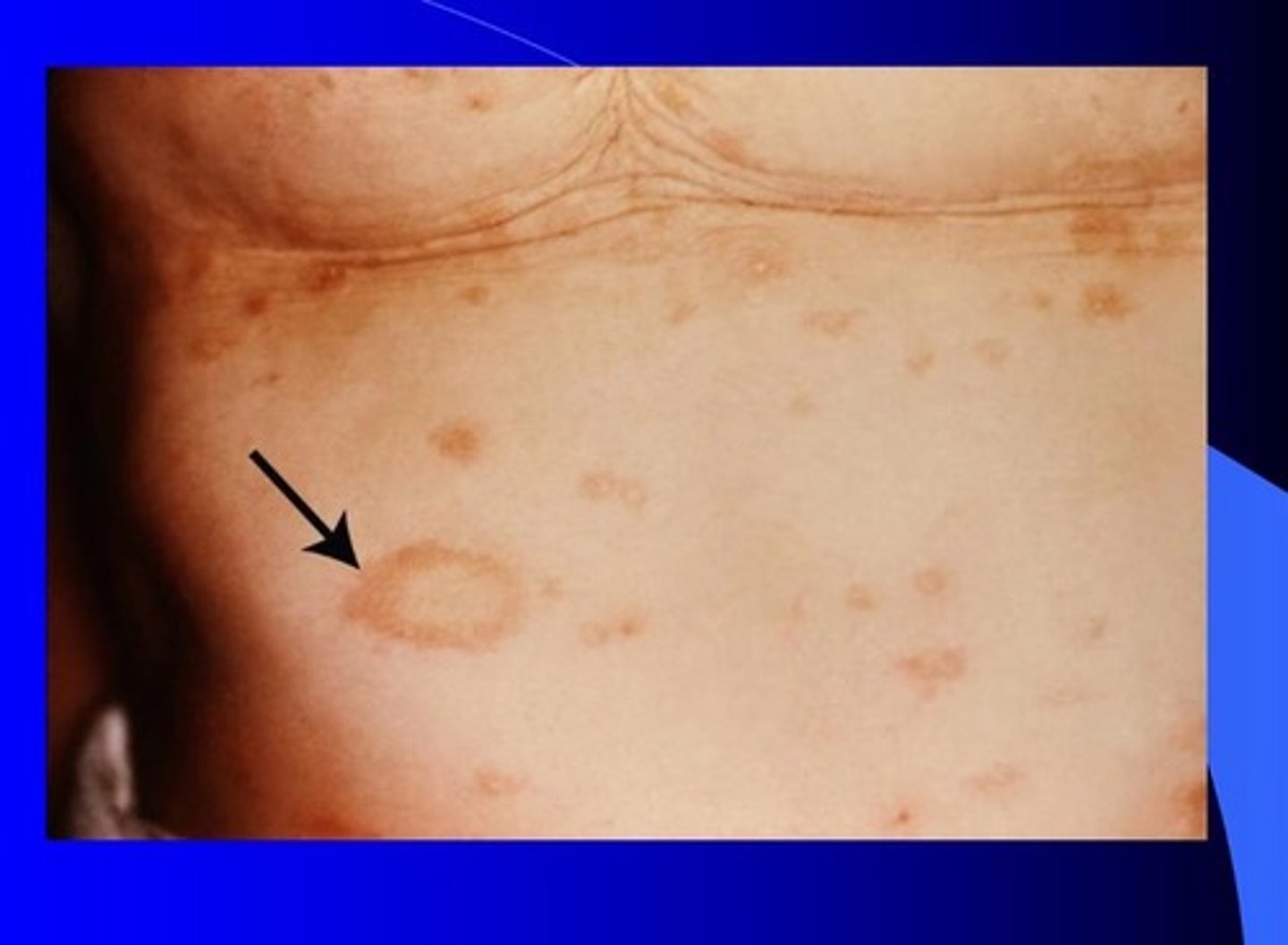 <p>Pityriasis rosea (herald patch)</p>