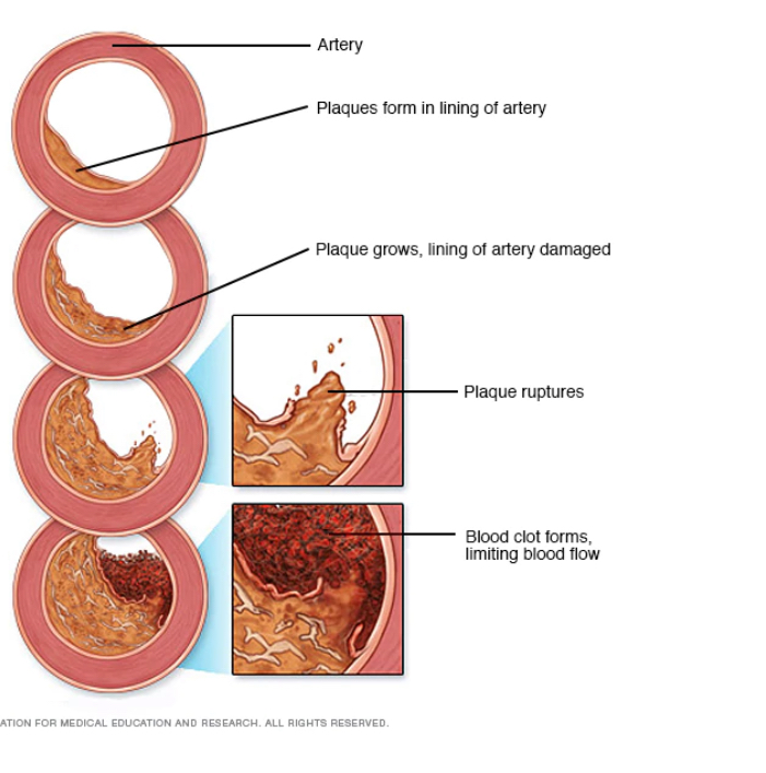 <p>Fatty streak- plaque forms in lining of artery</p><p>Fibrous plaque- accumulation of lipids covered by more lipid material ) collagen, elastic fiber deposits) </p><p>Complicated lesion- Fibrous plaque contains more fibrous tissue, more collagen, calcium and cellular debris</p><p>Ulcerative lesion- deterioration of the normally smooth surface of the fibrous cap. ( higher tendency to shed debris) </p><p>Intraplaque Hemorrhage- Plaque bleeding from within </p>