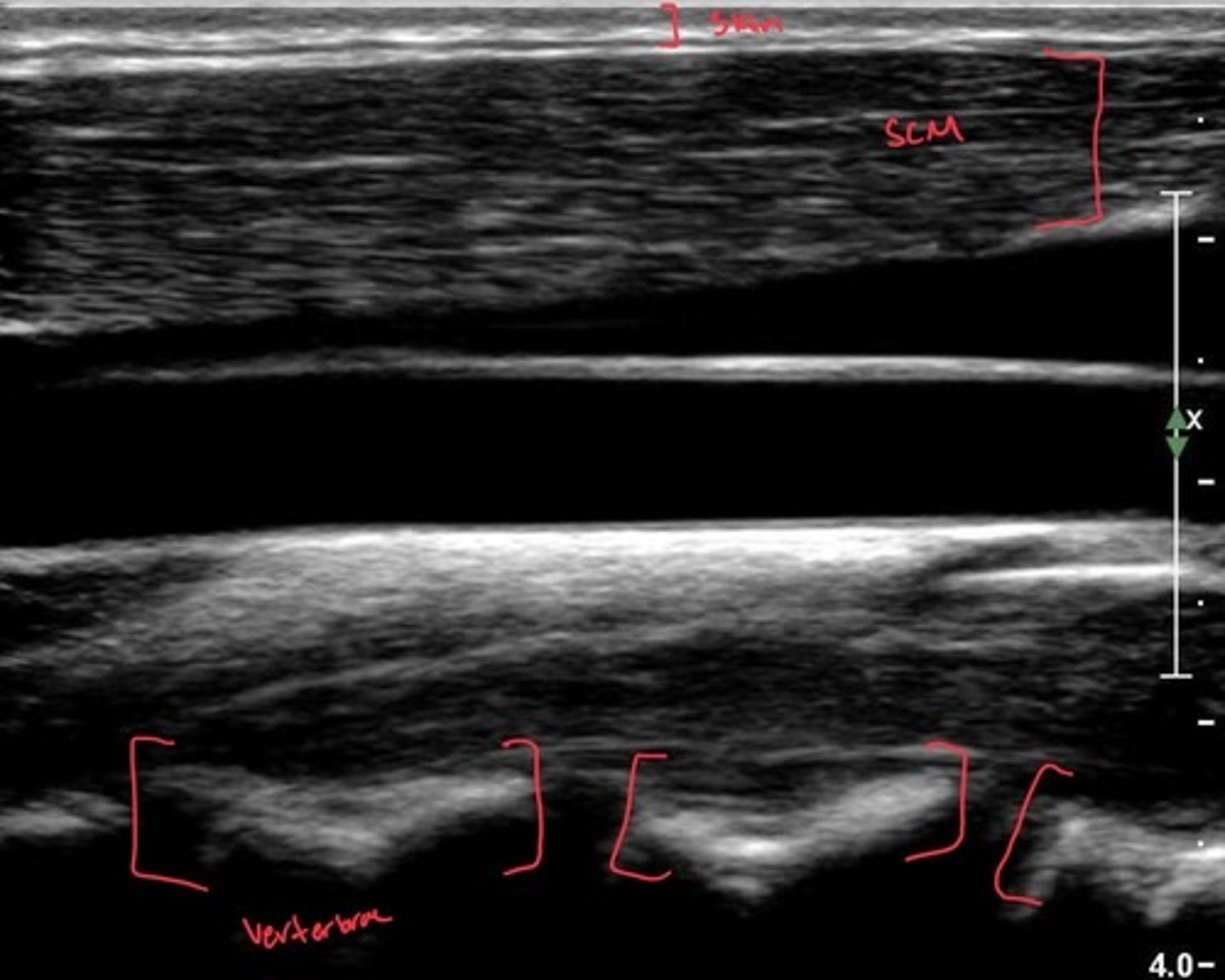 <p>Capable of producing echoes</p><p>white/grey indicating solid tissues, calcifications, or fat</p>