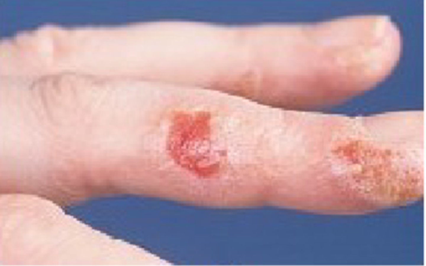 <p>= defect van de huid beperkt tot de epidermis</p><p>+ geen bloedingen zichtbaar</p>