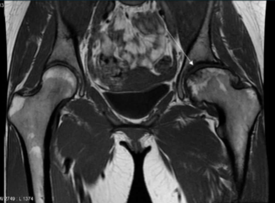 <p>Describe the pathology indicated by the arrow (Cor T1). </p>
