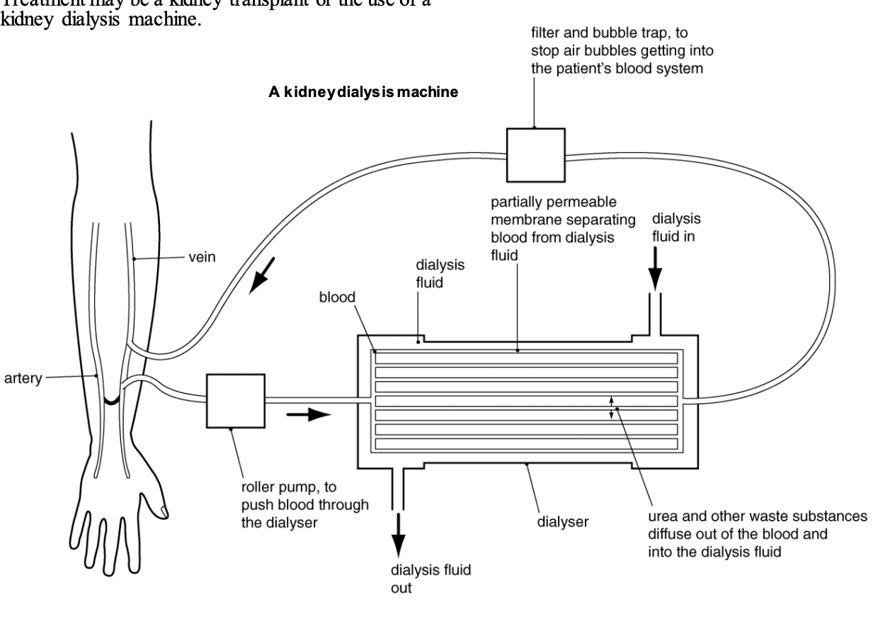 
1. 2 needles are inserted into your arm.
2. Each needle is connected to a flexible plastic tube connected to a dialyzer.
3. Roller pumps move along and compress tubing connecting the patient’s blood to the dialyzer, this produces continuous blood flow and helps push blood through to the dialyzer.
4. Dialysate is the fluid added into, and that passes through, the dialyser during dialysis. It’s composed form water, electrolytes, as well as salts, and is almost completely isotonic to the patient’s blood to aid osmoregulation. 
5. In the dialyser, partially permeable membranes surround tubes containing the blood, whilst dialysate is added to surround the tubes. Small molecules and waste products from the blood diffuse through the partially permeable membrane (larger molecules like blood cells and proteins stay in the blood) through to the dialysate, which then exits/leaves the dialyser. 
6. The filtered blood then leaves the dialyser through a tube, and returns to the patient’s body through the second tube. Along the way, there is a filter and bubble trap to stop air bubbles from getting into the patient’s blood system. 