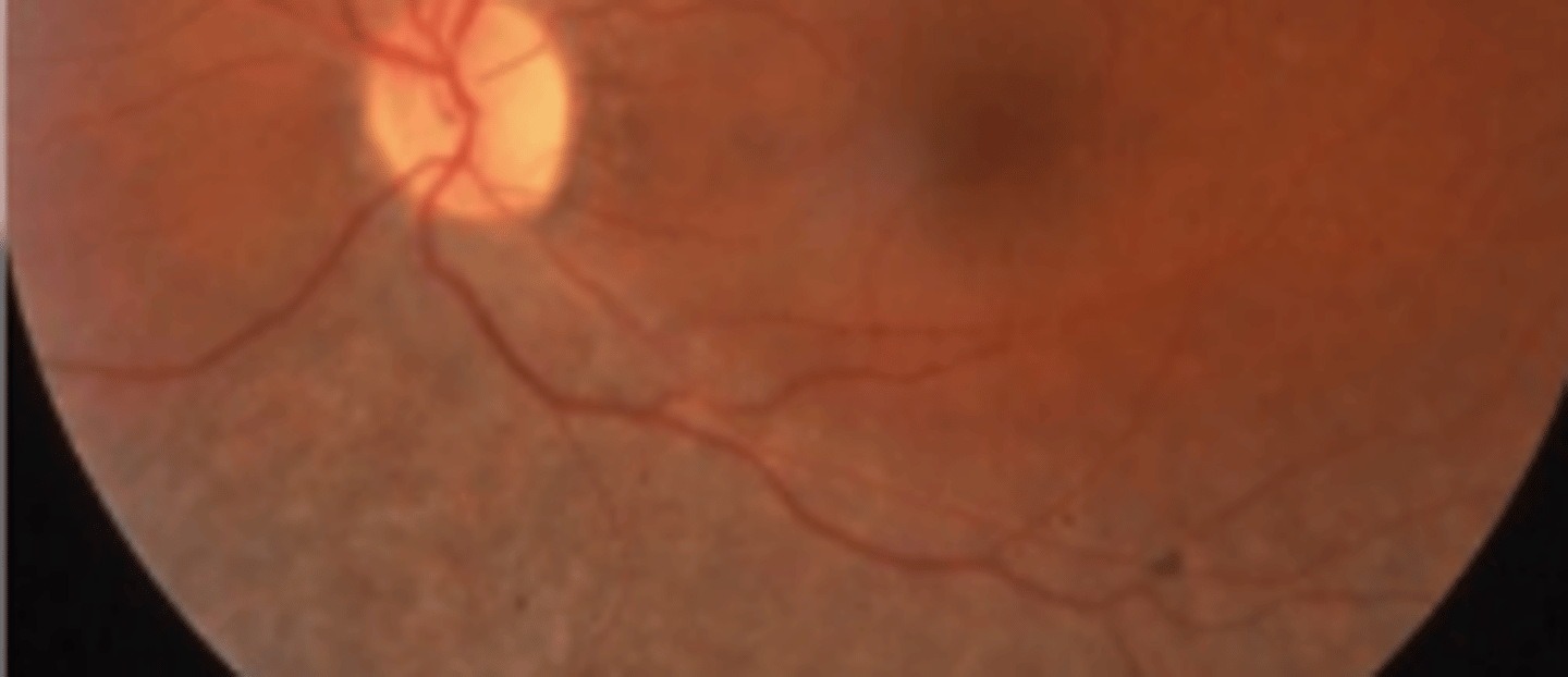 <p>atypical RP occurring only in one quadrant or only in one half (usually inferior) of the retina. Progression is slow and may remain stationary</p>