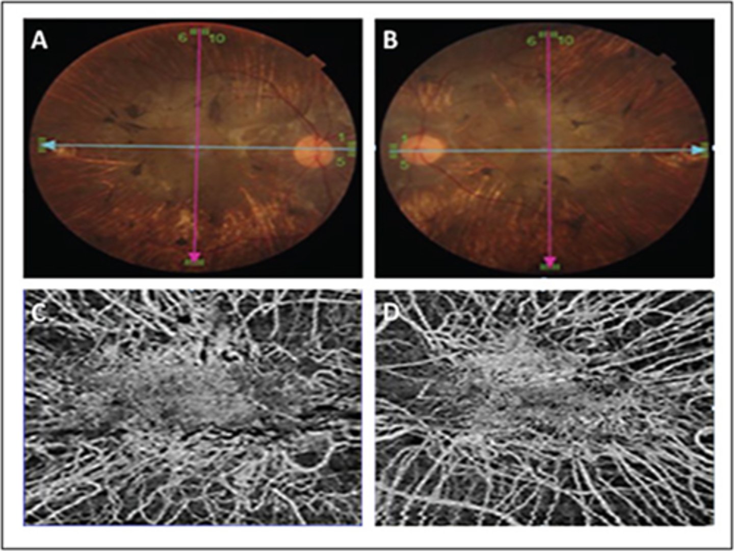 <p>scattered pigment clumping</p><p>visible large choroidal vessels</p><p>fovea = preserved choriocapillaris at the fovea</p><p>extrafovea = deficient choriocapillaris and visible medium, large choroidal vessels</p>