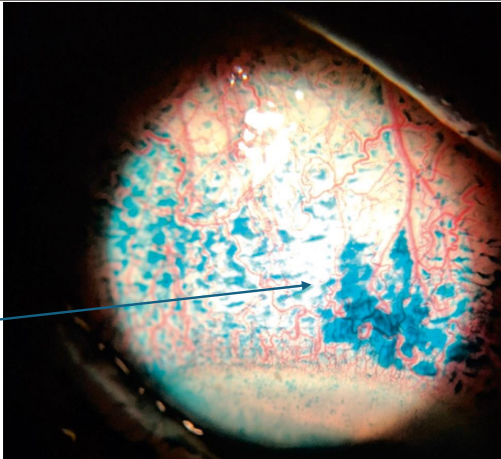 <p>• <u>Superior </u>epithelial defects and <u>superficial </u>punctate keratitis</p><p><u>sometimes have filaments</u> —&gt; liek when you rub dry skin and it rolls up</p><p><u>lissamine green stain</u></p>