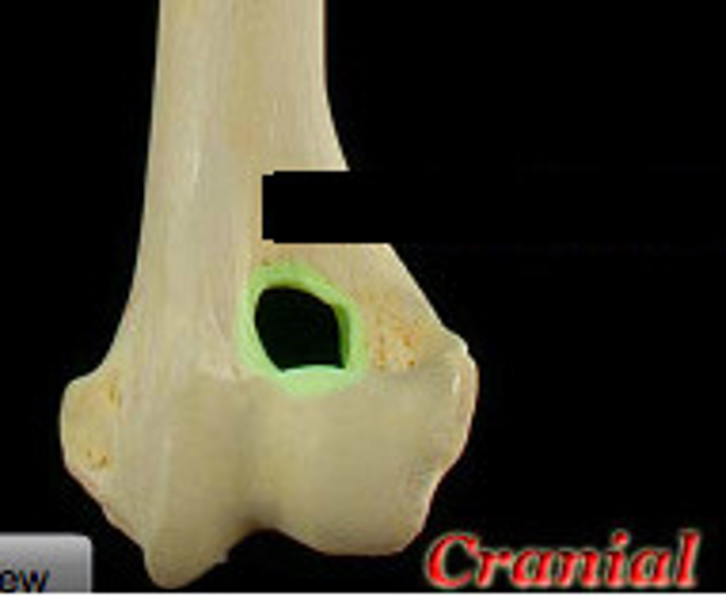 <p>hole in humerus in which the radial fossa and the olecranon fossa communicate</p>
