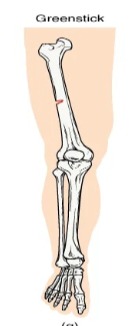 <p>A partial fracture in which only one side of the bone is broken </p>