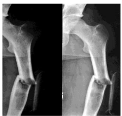 <ul><li><p>Frakturen bei Mehrfachverletzten</p></li><li><p>Gelenkfrakturen</p></li><li><p>instabile Frakturen</p></li><li><p>offene Frakturen</p></li><li><p>Frakturen mit Gefäß-/Nervenschaden</p></li><li><p>pathologische Frakturen</p></li></ul><p></p>