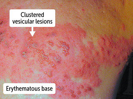 <p>Herpes zoster, known as shingles, is a <strong>painful vesicular rash in dermatomal distribution secondary to reactivation of varicella zoster virus, </strong>which is a dsDNA virus</p><ul><li><p>Will cause pain, medicate for pain control </p></li></ul><p></p>