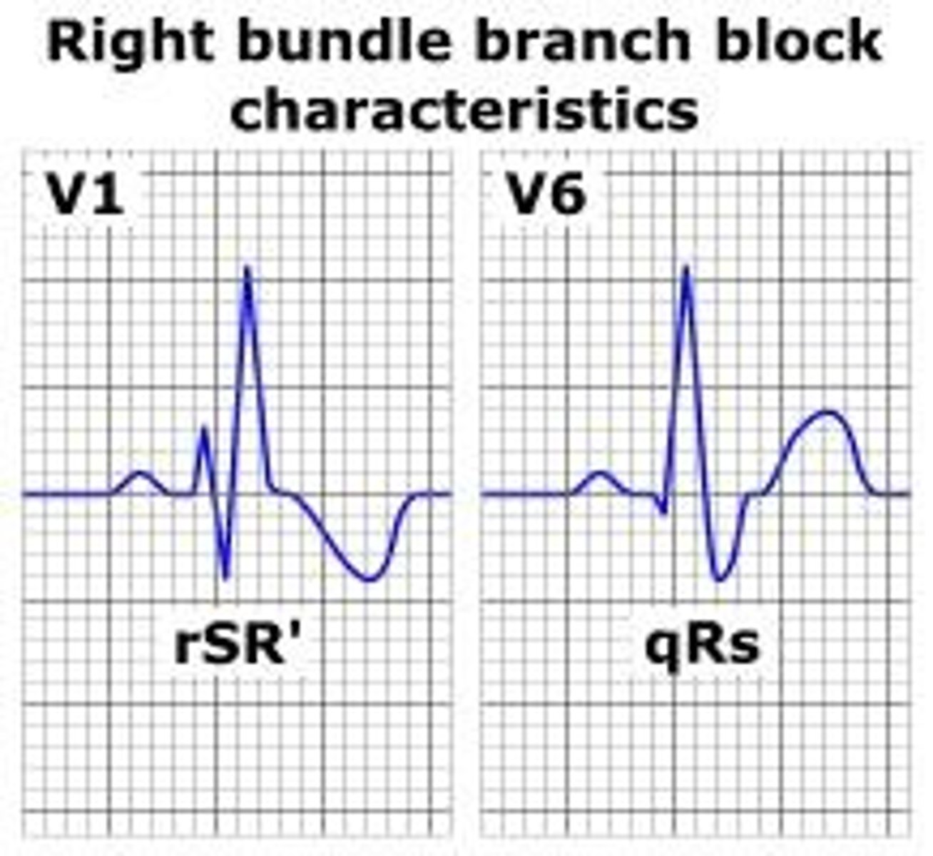 <p>The test should be stopped as ST depression in leads V1-V3 is not associated with ischemia.</p>