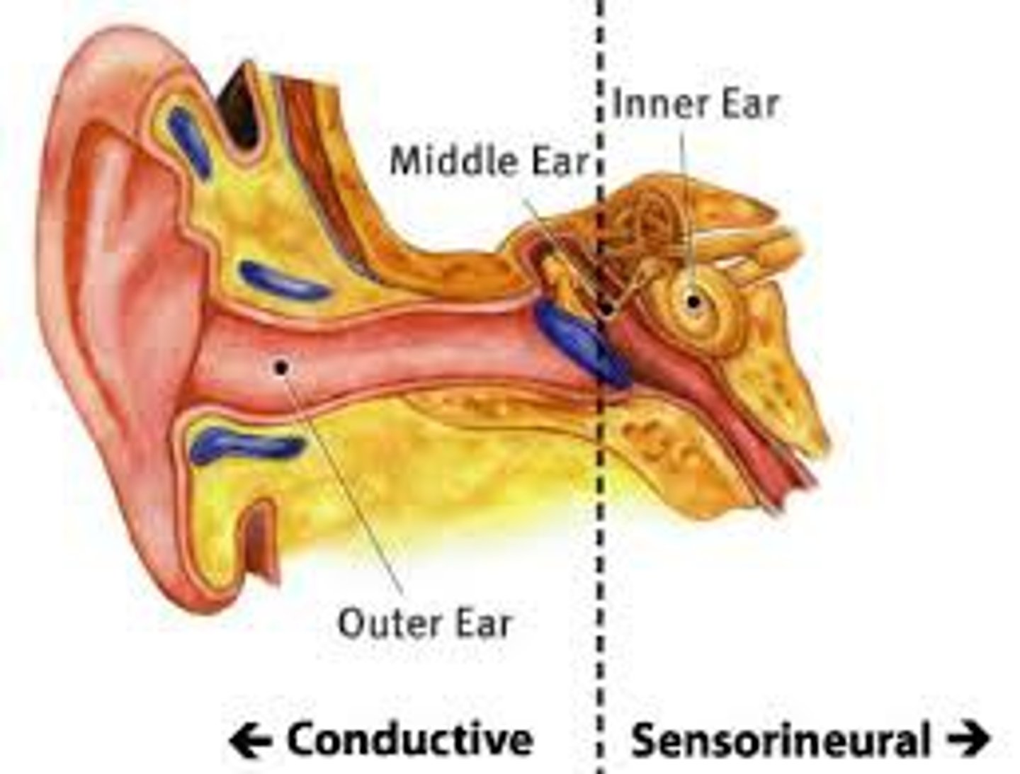 <p>Caused by damage to the mechanical system that conducts sound waves to the cochlea</p>