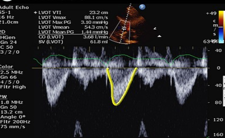 <p>distance traveled by blood cells in one cardiac cycle</p><p>used to calculate SV, CO, AO valve area</p><ul><li><p>trace flow profile</p><ul><li><p>VTI, peak V, mean V, peak P gradient, mean P gradient</p></li></ul></li></ul><p></p>