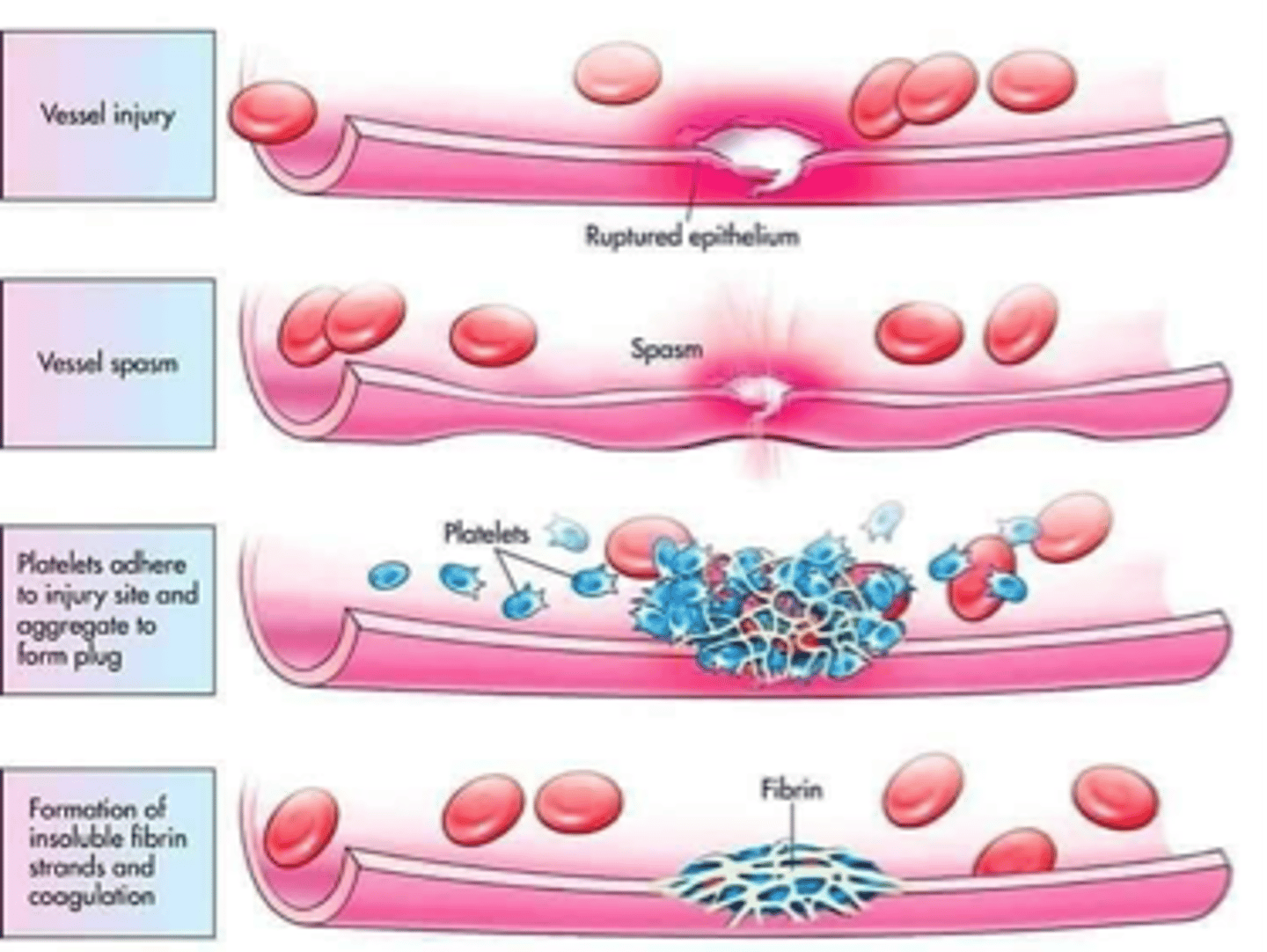 <p>Permanent plug (clot) is actually insoluble fibrin</p>