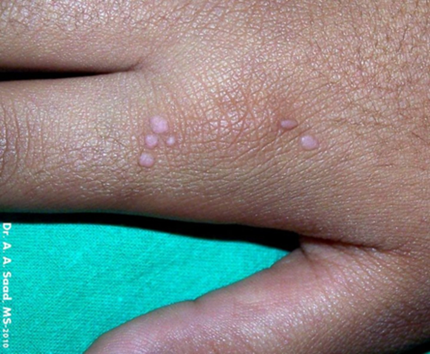 <p>= talrijke platte wratjes in gelaat, op handruggen, voorarmen, knieën bij kinderen </p><ul><li><p>vaak Koebner fenomeen </p></li><li><p>normale immuniteit → spontaan verdwijnen binnen de 2 jaar</p></li></ul><p>R/ </p><ul><li><p>Tretinoine of adapalene creme </p></li><li><p>Cryotherapie</p></li></ul><p></p>