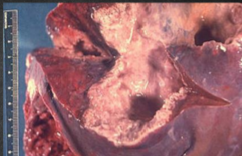 <p>Abscess found on the right lobe of the liver may penetrate the diaphragm and cause lung disease</p><p></p>