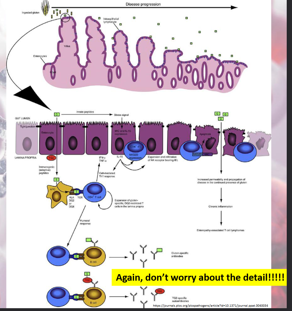 <ul><li><p><span><span>When the body's immune system will attack and destroy healthy body tissue by mistake</span></span></p></li><li><p><span><span>Error in the system</span></span></p></li><li><p>Occurs when there is too little of a T-Suppressor response</p></li><li><p><span><span>Body will start to attack cells that are healthy, and that shouldn't be attacked</span></span></p></li><li><p><span><span>Association with autoimmune disease, allergies, graft rejection, inflammatory bowel disease</span></span></p></li></ul><p></p>
