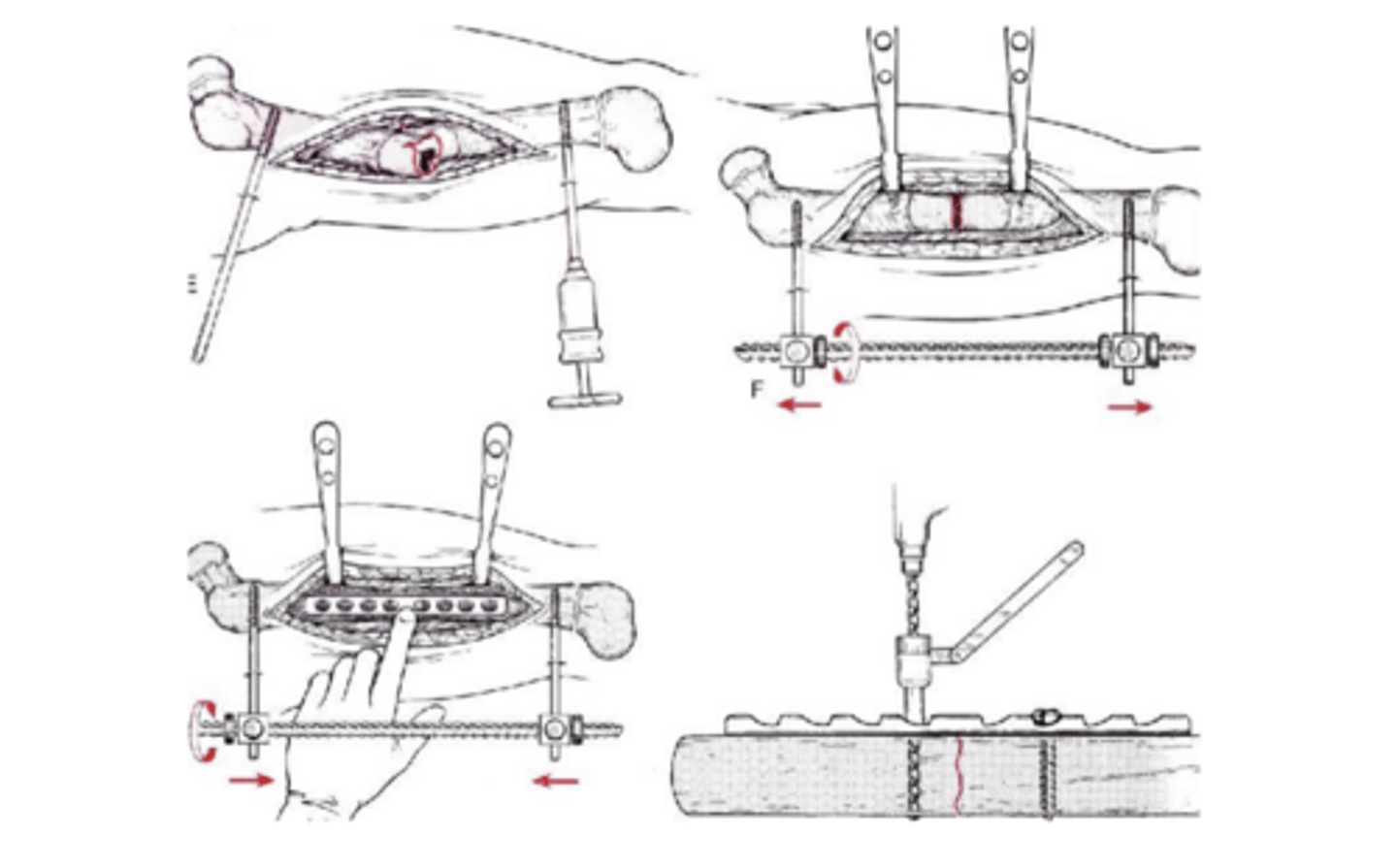 <p>surgically procedure using plates and screws to hold fx in place</p>