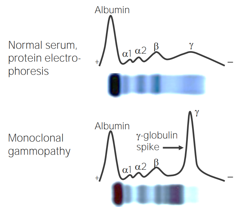 <p>Gamma-globulin protein spike! </p>