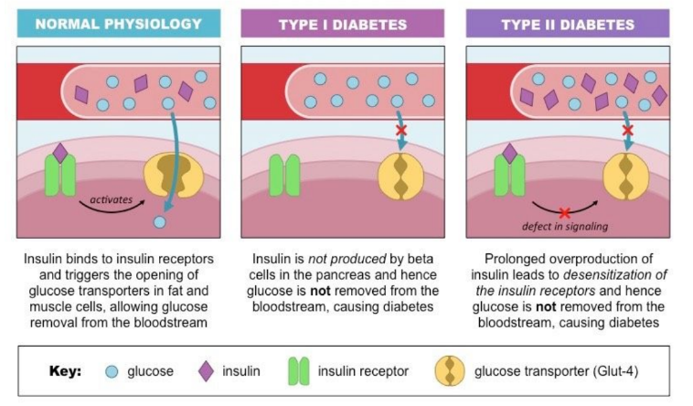 Diabetes mellitus is a metabolic disorder that results from a high blood glucose concentration over a prolonged period 

\
Type 1 (Insulin-Dependent Diabetes Mellitus (IDDM)): 

* Early onset 
* Body does not produce sufficient insulin 
* Caused by destruction of beta cells (autoimmune) 
* Requires insulin injections to regulate blood glucose 

\
Type 2 (Non Insulin Dependent Diabetes Mellitus (NIDDM)): 

* Late onset 
* Body does not respond to insulin production 
* Caused by down-regulation of insulin receptors 
* Controlled by managing diet/ lifestyle 