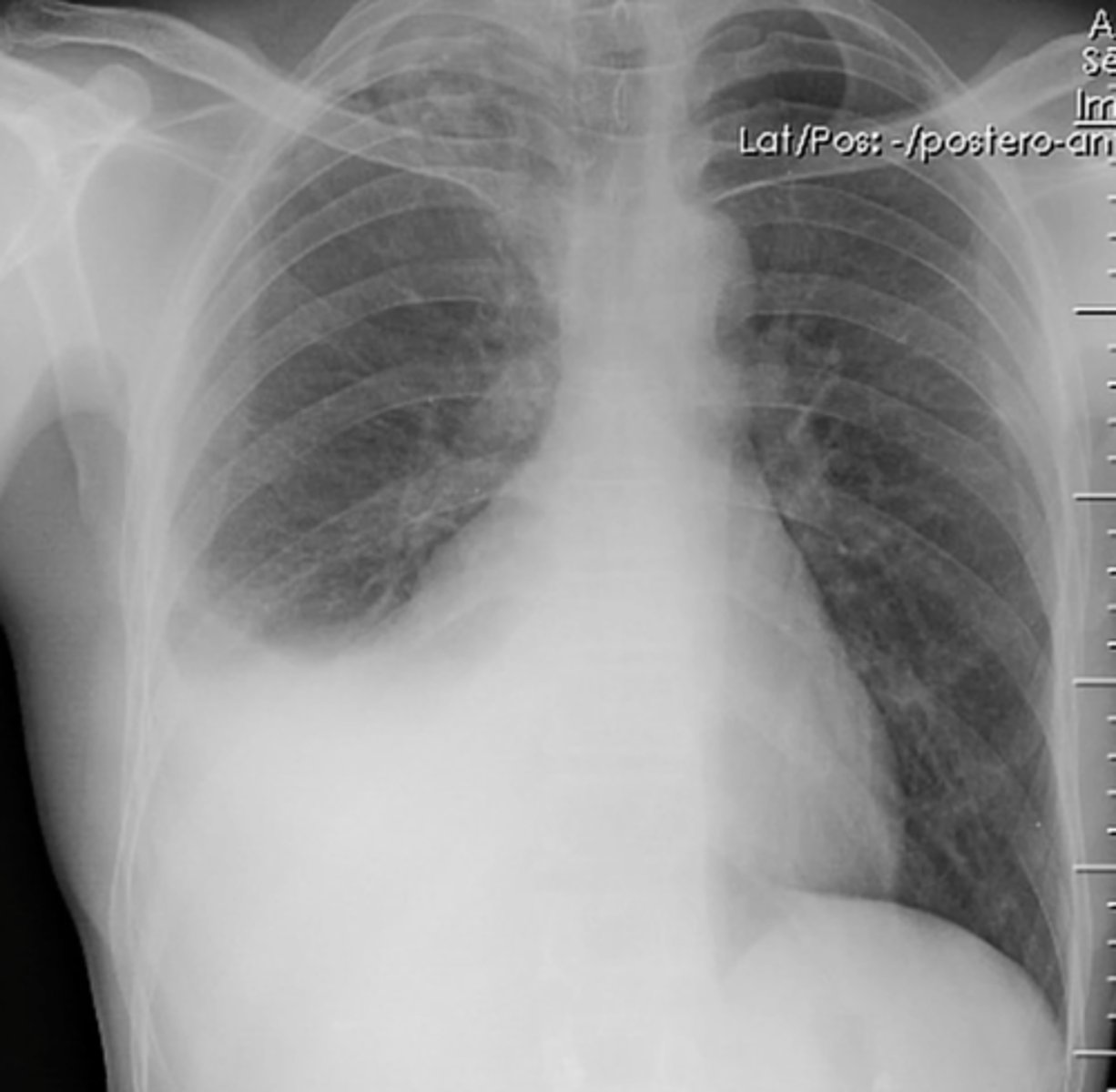 <p>(evaluating AP CXR) fluid in the pleural space (not lung itself)</p>