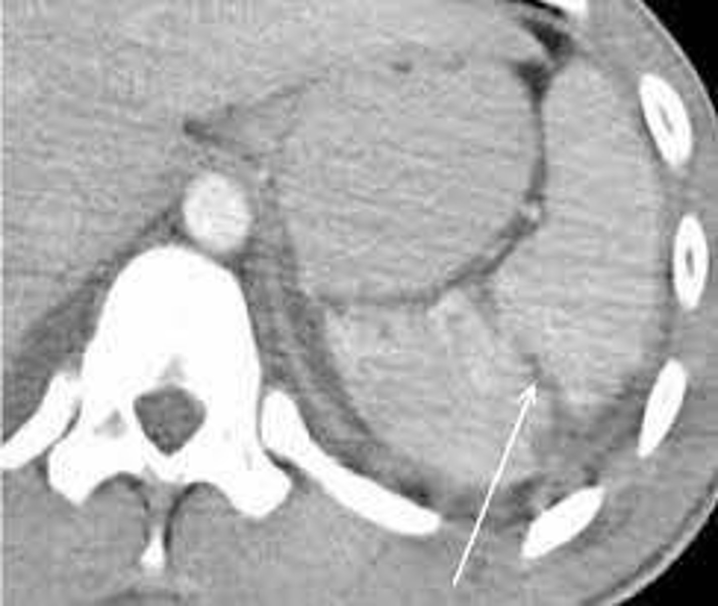 <p>The spleen.</p>