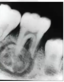 <p>diagnosis? radiopaque lesion with radiolucent border in molar area, can be symptomatic </p>