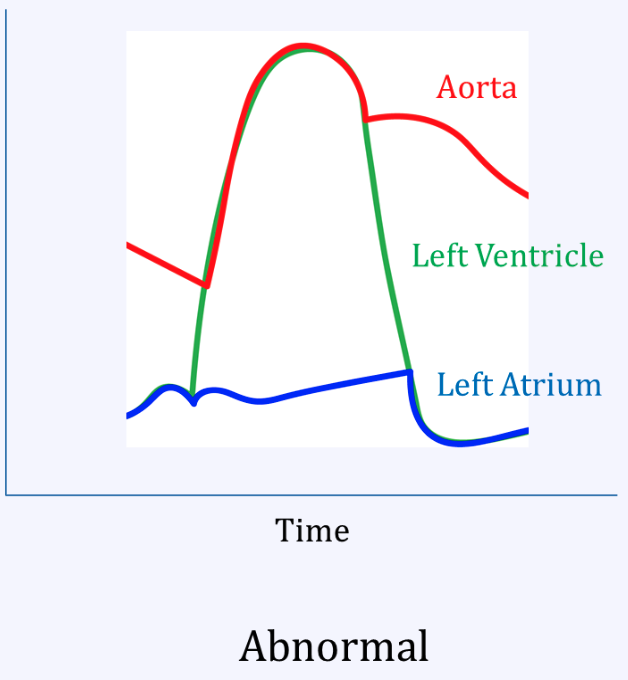 <p>Aortic regurg</p>