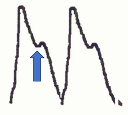 <ul><li><p>rapid upstroke</p></li><li><p>sharp peak</p></li><li><p>prominent dicrotic notch</p></li></ul>