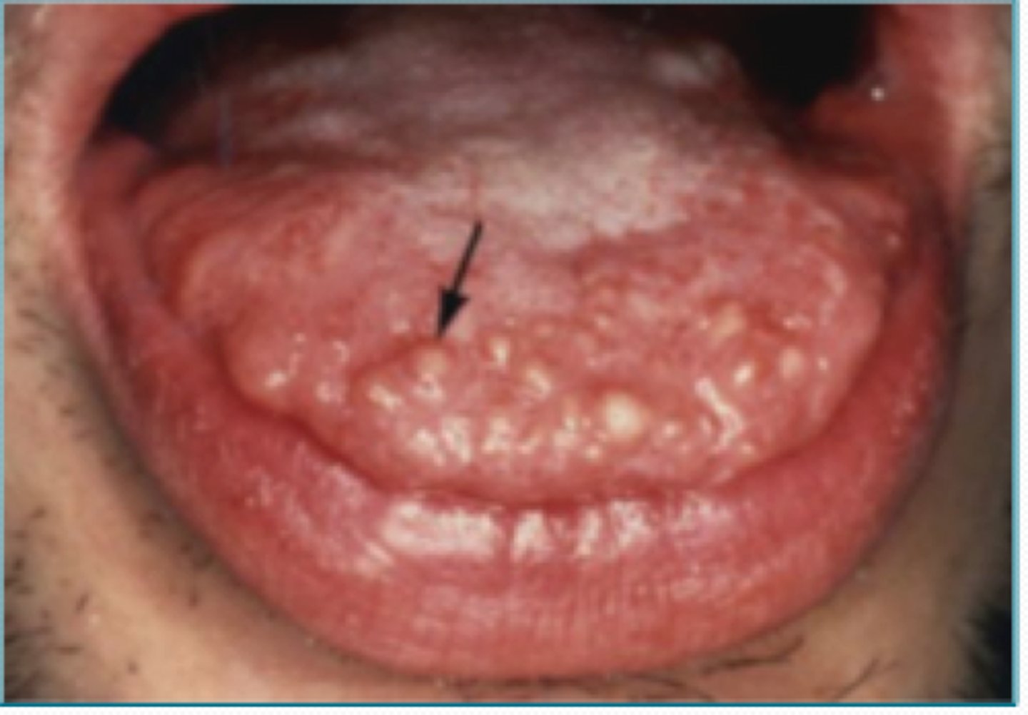 <p>____ ____ are a benign neural lesion and is associated with multiple endocrine neoplasia type 2B (MEN2B), its soft painless papules or nodules located on the lips, anterior tongue, BM, gingiva and palate. Its treated by surgical excision, however, multiple lesions should be evaluated for MEN IIB</p><p>-not common</p>